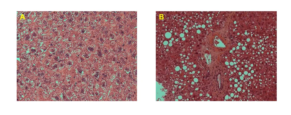  Liver pathology A. Healthy liver. B. NAFLD.