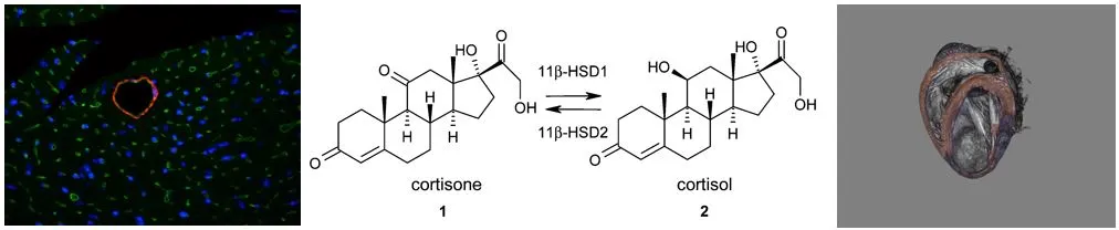 Combination of three images of acute-myocardial infarction images, including cortisone cortisol OC diagram
