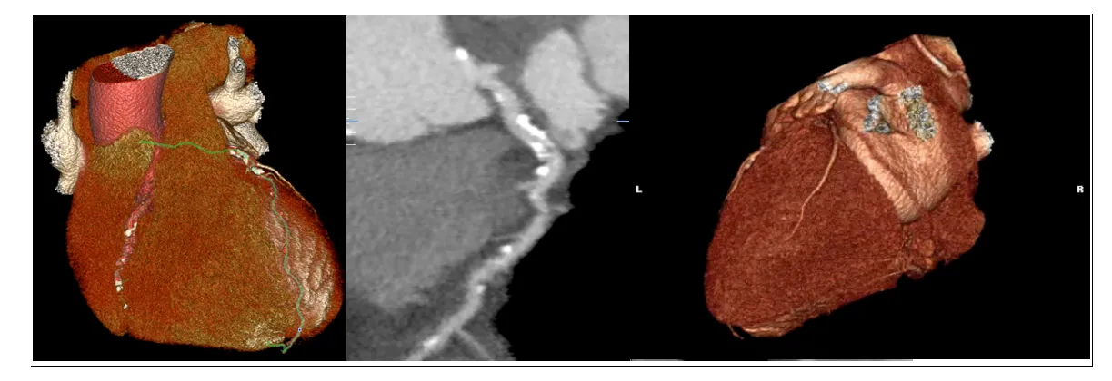 combination of three images of the heart