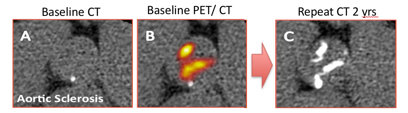 combined image of three photos, outlining aortic sclerosis