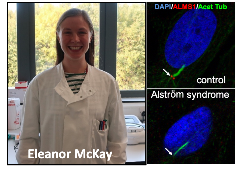 Eleanor McKay and alstrom syndrome research images