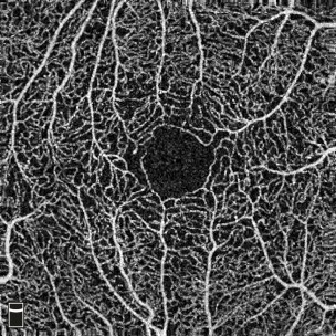 retina image taken by OCT imaging technology